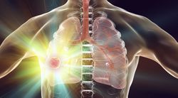 Imfinzi Boosts Lung Cancer Outcomes, But Some Patients Are Not Given the Drug