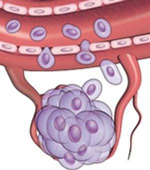 Understanding Metastasis