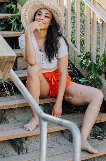 Ewing sarcoma survivor, Brandi Benson, sits on stairs, revealing her cancer scar on her inner thigh