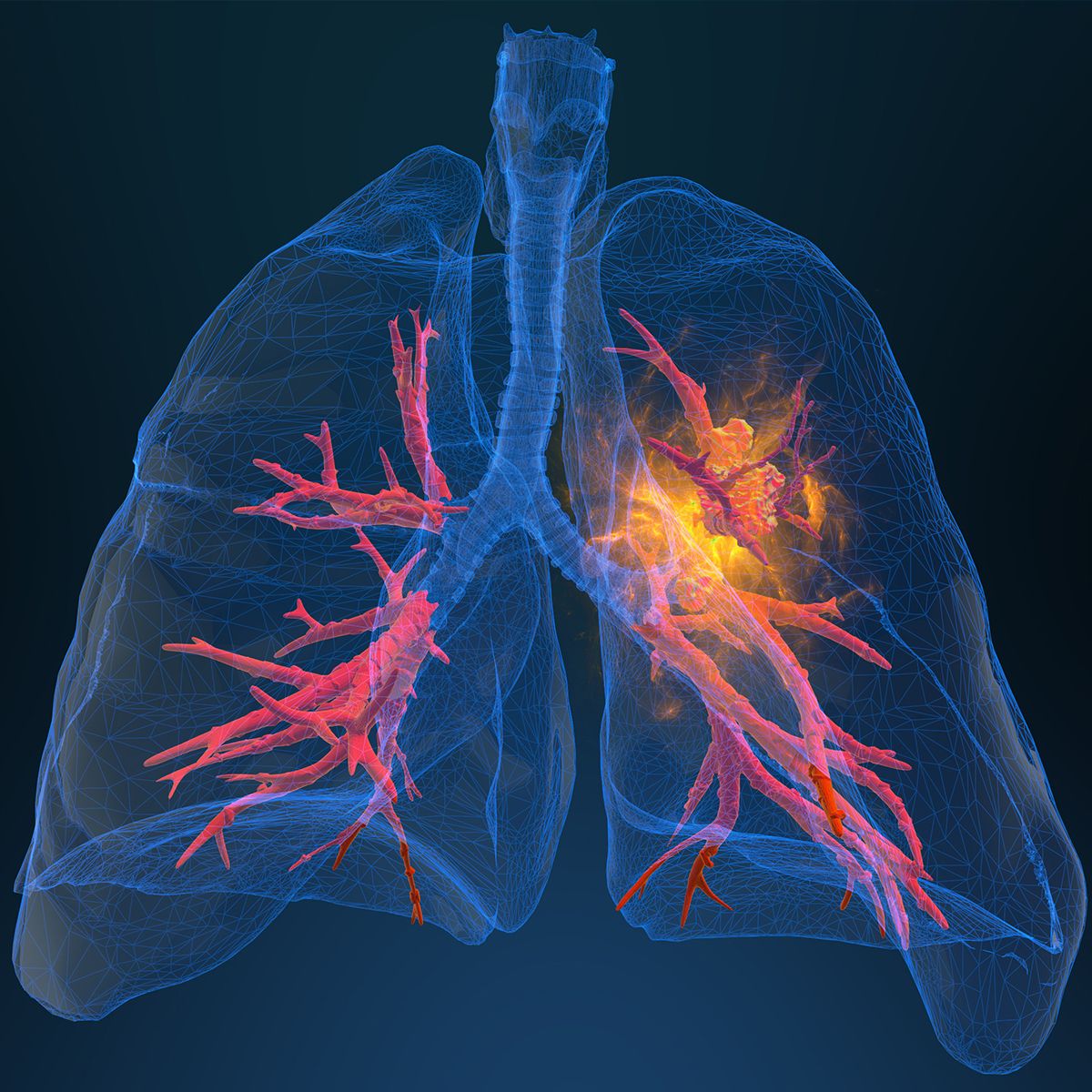 Biomarker Testing Remains Crucial for Young Patients With Lung Cancer