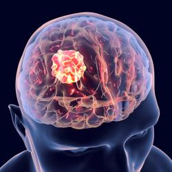 Temferon Linked to Long-Term Survival in Some With Glioblastoma 