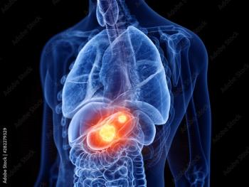 3D image of a body with gastric tumors highlighted