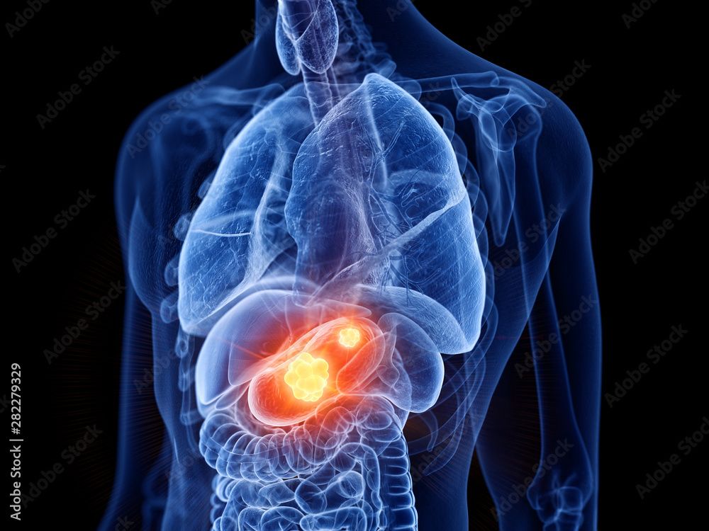Keytruda For Stage 4 Stomach Cancer Keytruda Combo Boosts Survival in Gastric Cancer Subtype