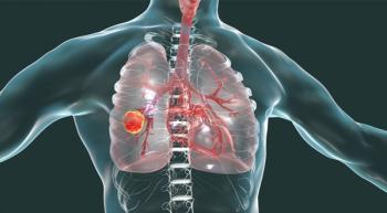 Illustration of a person's lungs with a tumor in their right lung. 