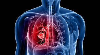 Image of lung cancer in the right lung.
