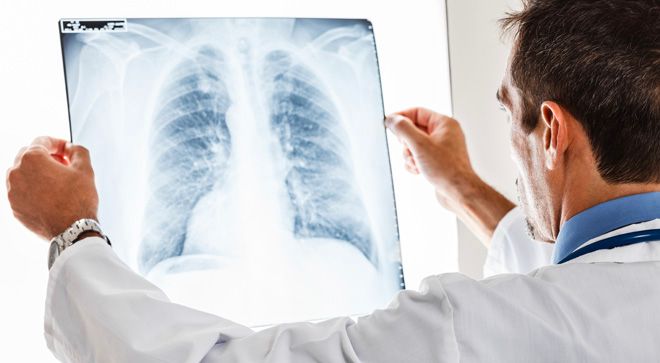 ベルデン四朗　No.1 Patients With Stage 4 NSCLC at Diagnosis Tend to Have Poorer