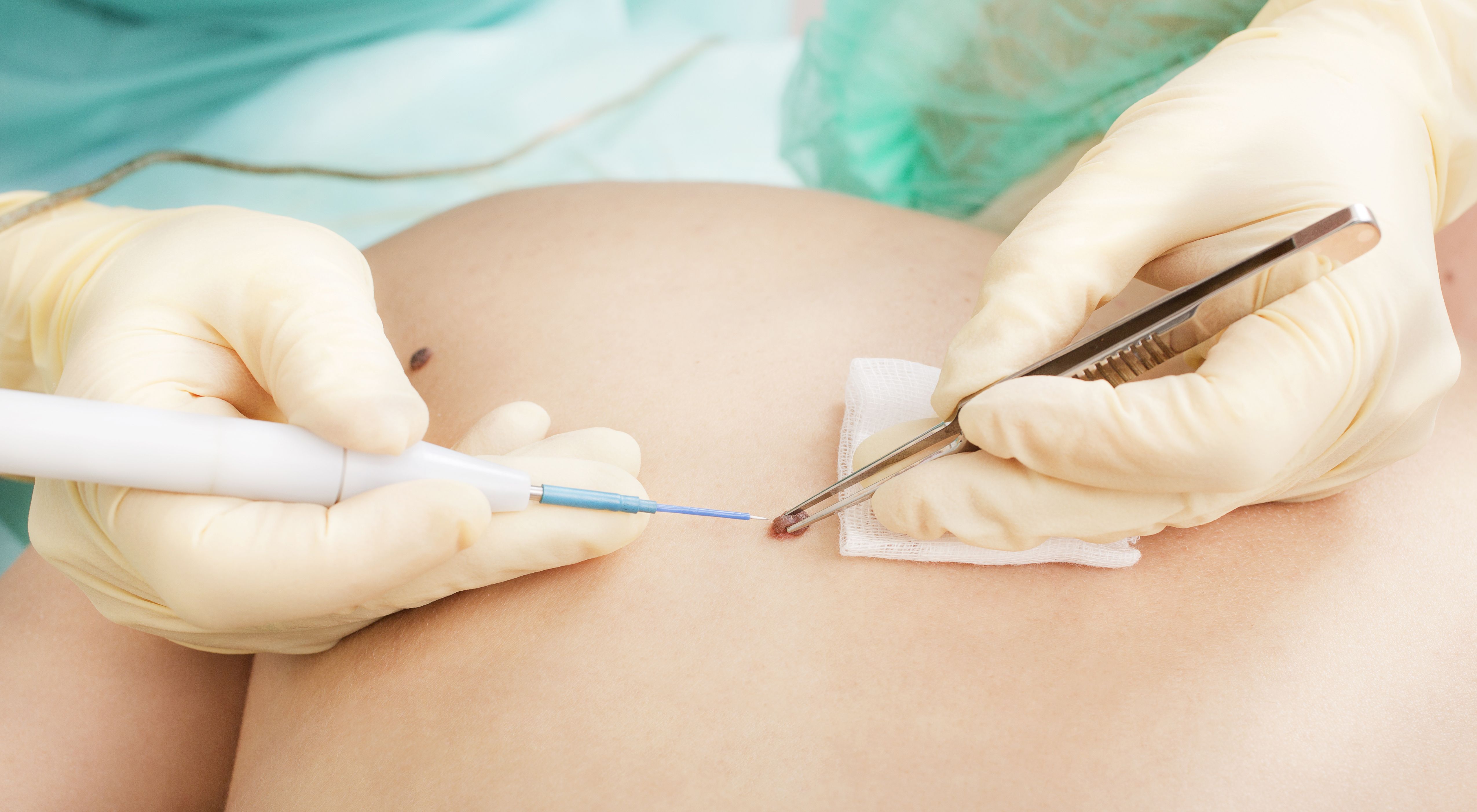 Understanding Adjuvant and Neoadjuvant Melanoma Treatment