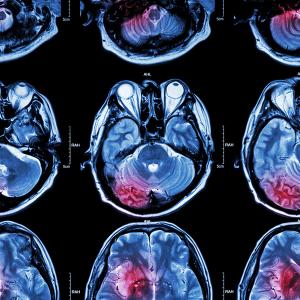 Each May, for over a decade, the End Brain Cancer Initiative (EBCI) has presented the National HOPE Award to a brain cancer patient who deeply inspires us: © stock.adobe.com.