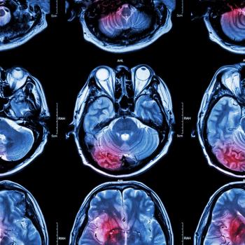 A nationwide survey of patients and caregivers has found educational and financial disparities in brain cancer care: © stock.adobe.com.
