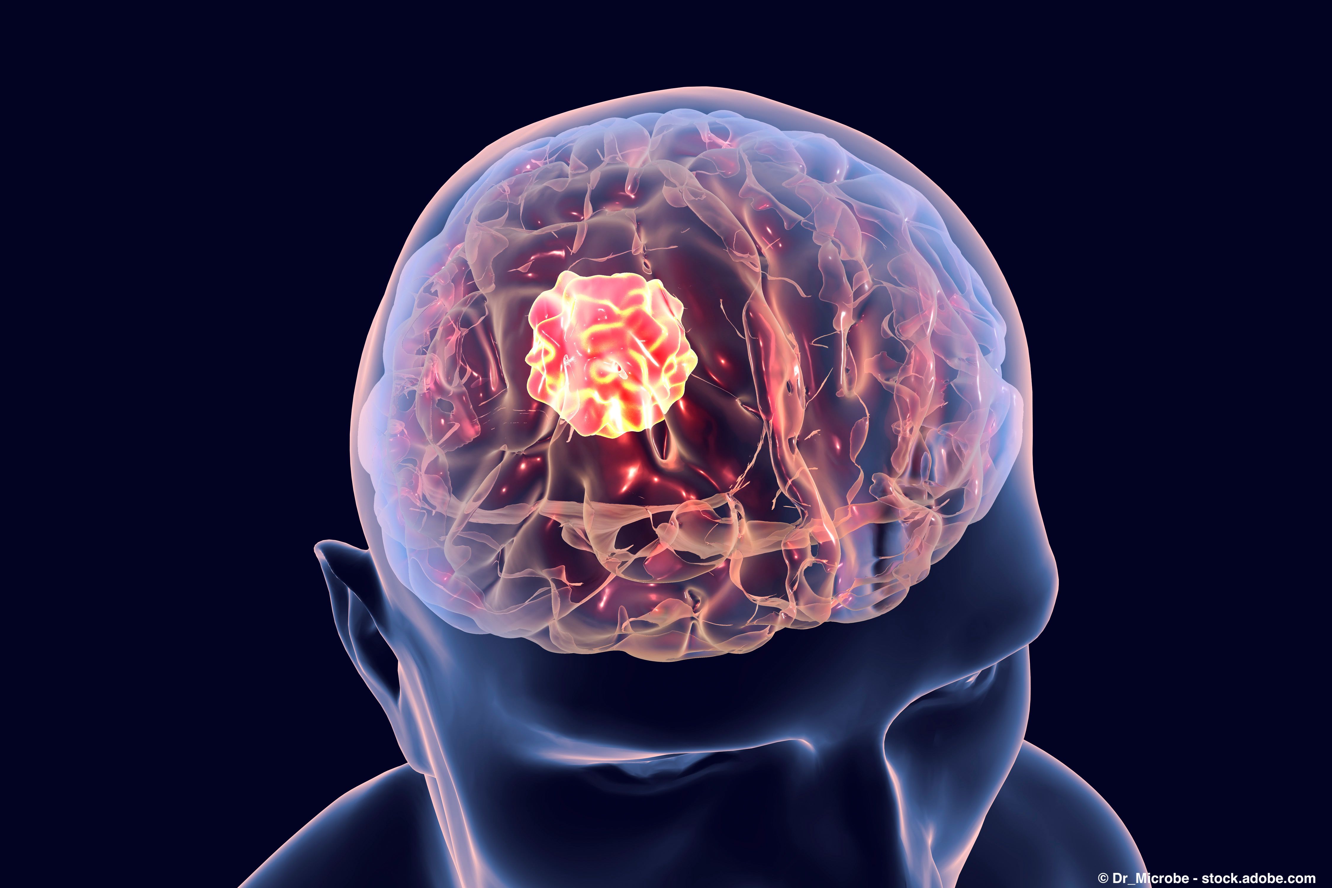 Tafinlar and Mekinist combo has efficacy among patients with gliomas: © Dr_Microbe - stock.adobe.com 