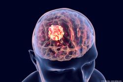 Veliparib and Temozolomide Combo Does Not Significantly Extend Survival for Patients With Glioma