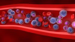 Lynozyfic Shows Early Responses for Newly Diagnosed Myeloma 