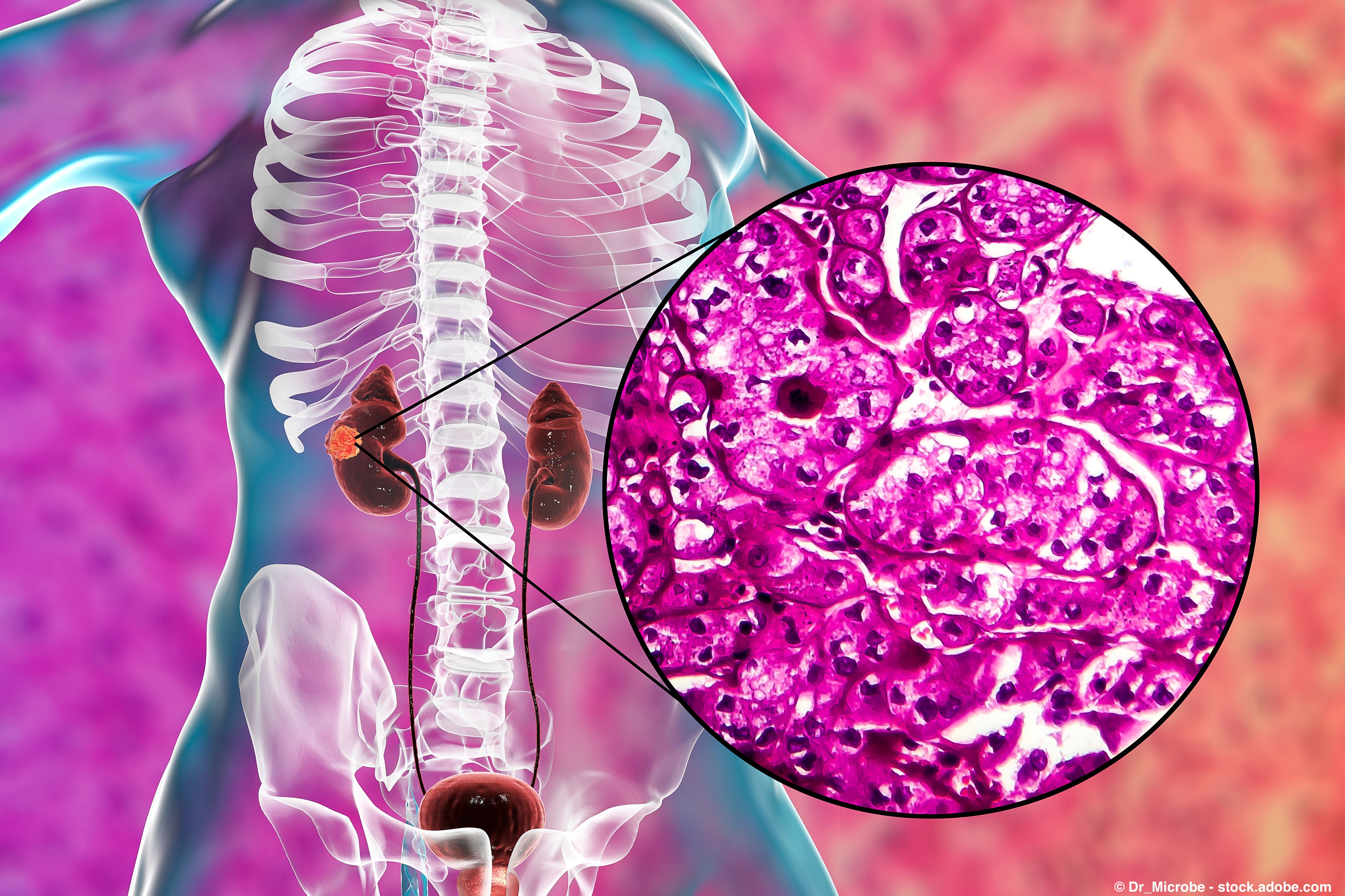 Fruzaqla plus sintilimab slowed progression in the second line for locally advanced or metastatic renal cell carcinoma: © Dr_Microbe - stock.adobe.com