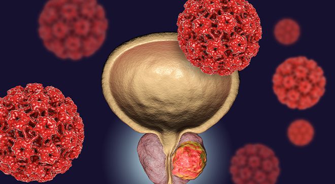 Castration ‘An Unfortunate Term’ for Key Part of Prostate Cancer Treatment