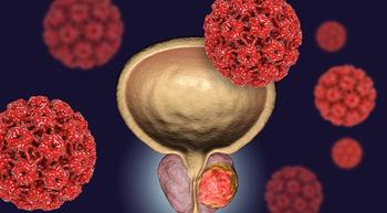 Zytiga and Prednisone Plus Erleada Reduces Risk of Disease Progression in Prostate Cancer Subtype