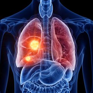 The FDA granted fast track status to DB-1310 for advanced nonsquamous NSCLC: © stock.adobe.com.