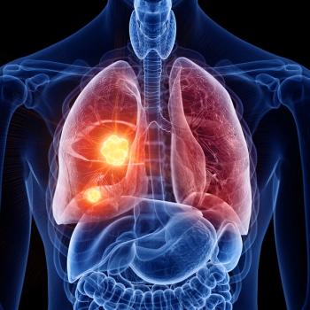The FDA granted fast track status to DB-1310 for advanced nonsquamous NSCLC: © stock.adobe.com.