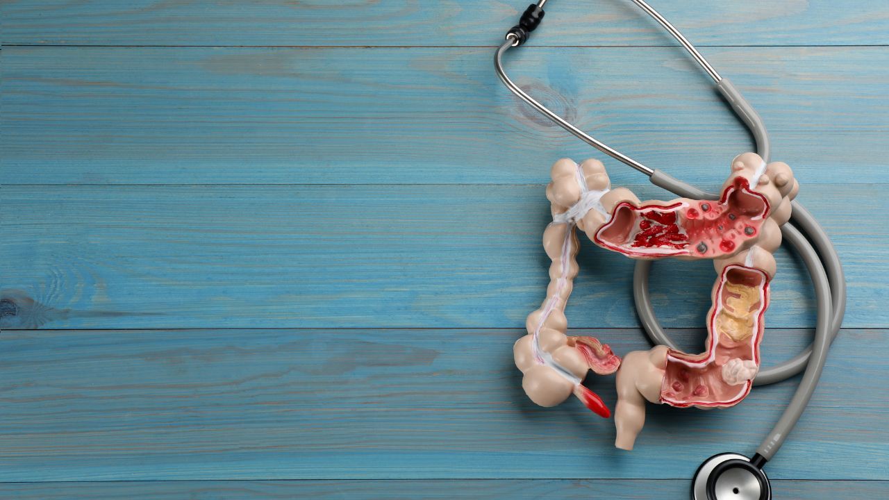 PDS01ADC showed high response rates in metastatic colorectal cancer in a phase 2 trial: © stock.adobe.com.