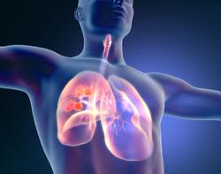 Novel Drug-Tecentriq Combo to Be Studied in Non-Small Cell Lung Cancer