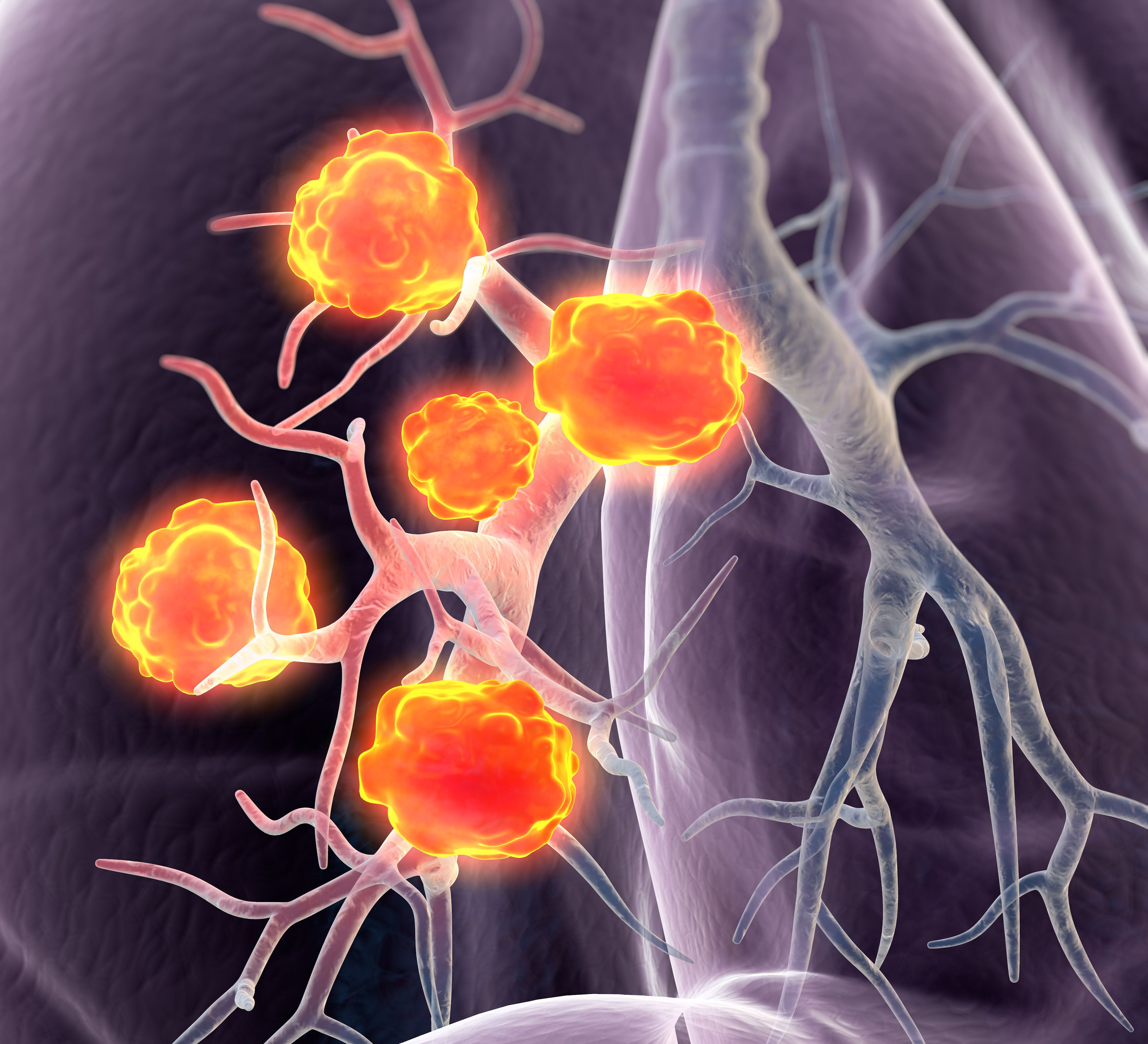 Chemotherapy With Immunotherapy Improves Overall Survival For Extensive Stage Small Cell Lung Cancer 8219