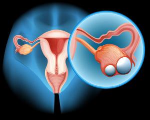 Adding Lynparza to Avastin Significantly Improves Survival in Ovarian Cancer