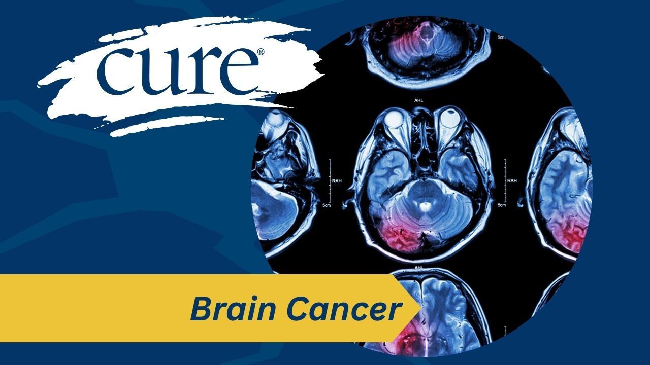 In patients with operable, newly diagnosed brain metastases, GammaTile was associated with reduction in the risk of tumor recurrence or death.