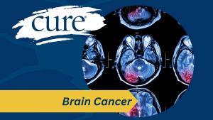 In patients with operable, newly diagnosed brain metastases, GammaTile was associated with reduction in the risk of tumor recurrence or death.