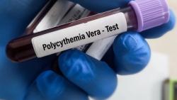 Understanding Stage 1 Polycythemia Vera: What Every Patient Should Know