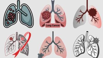 Lung cancer can be overwhelming, but learning about types, stages, treatments and support can help: © stock.adobe.com.