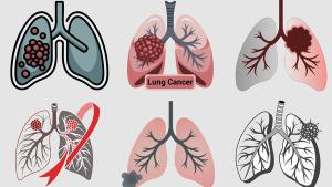 LiveLung invites the Charlotte lung cancer community to its monthly educational meeting: © stock.adobe.com.