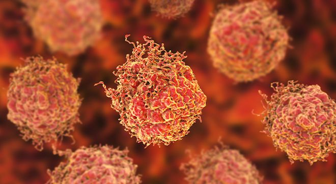 prostate cancer image