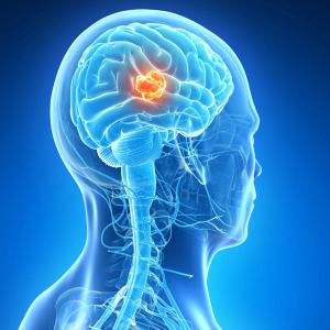 Genomic Profiling Provides Much-Needed Prognostic Data in Glioma