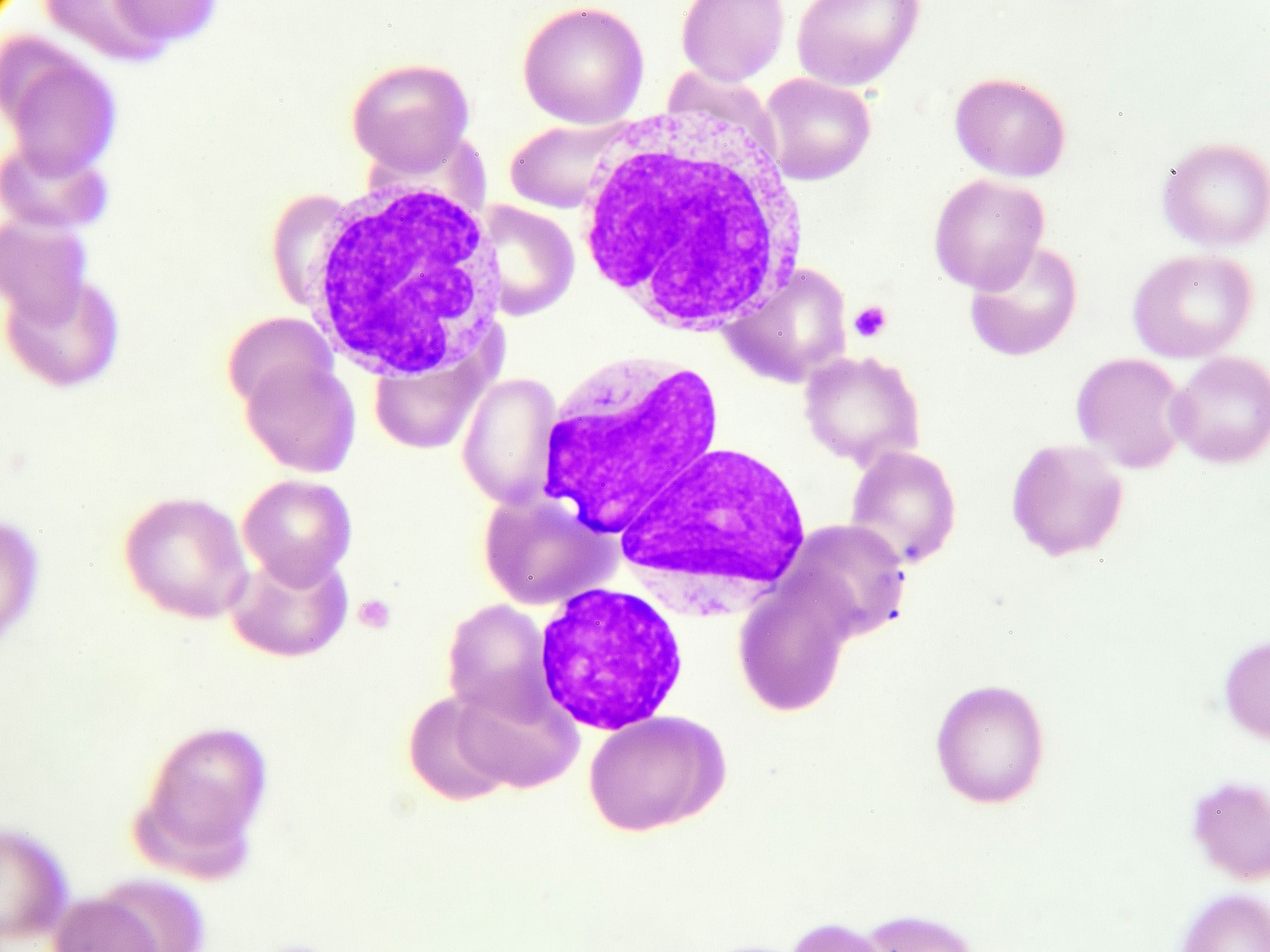 Acute Myeloid Leukemia Histology