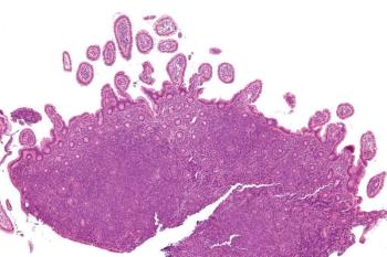 image of non-Hodgkin Lymphoma