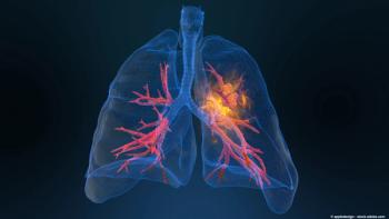 Image of lung cancer.