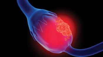 image of ovarian cancer
