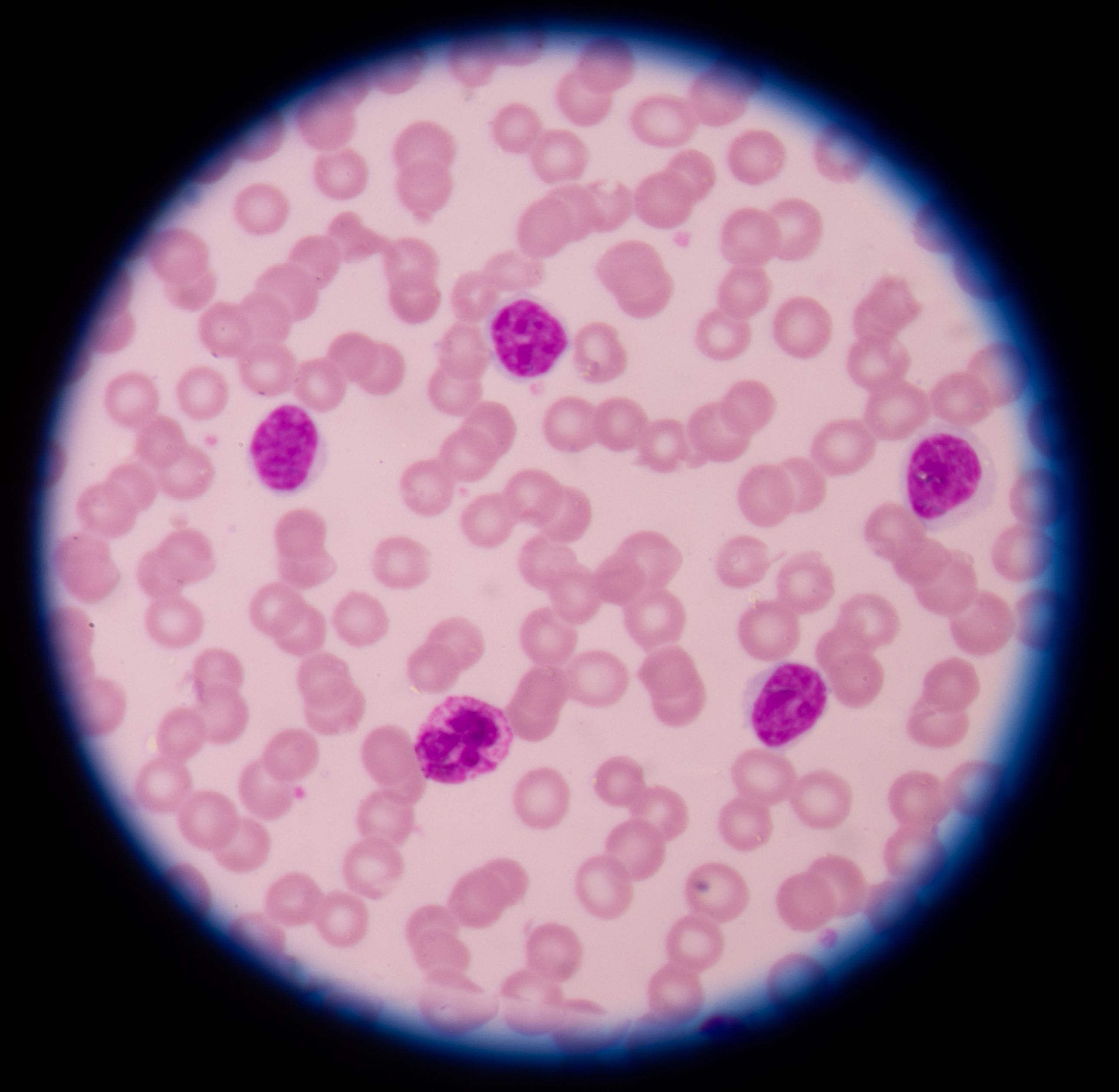 leukemia cells