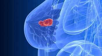 Adding S-1 to Endocrine Therapy Improves Survival in Japanese Patients with Breast Cancer