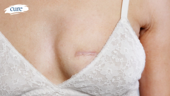 Image of Mastectomy