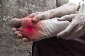 Tingling and burning sensation in foot of Asian man. Foot pain. Sensory neuropathy problems. Foot nerves problems. Plantar fasciitis. | Image credit: © ZayNyi - © stock.adobe.com