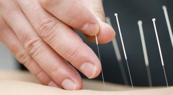 Image of a person receiving acupuncture.