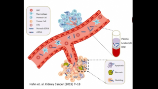 Can a Blood Test Predict Lymphoma Relapse?
