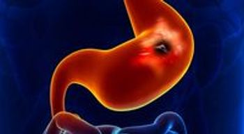Image of a tumor on the pancreas.