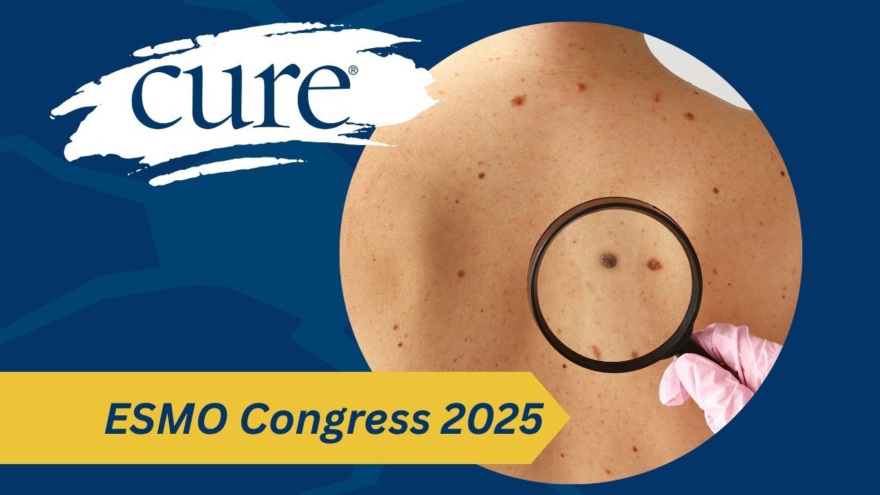 melanoma