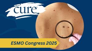 melanoma