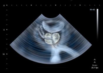 prostate scan
