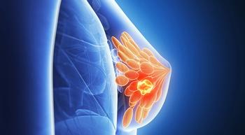 Tesetaxel with Reduced Dose of Xeloda Improves Progression-Free Survival in Breast Cancer