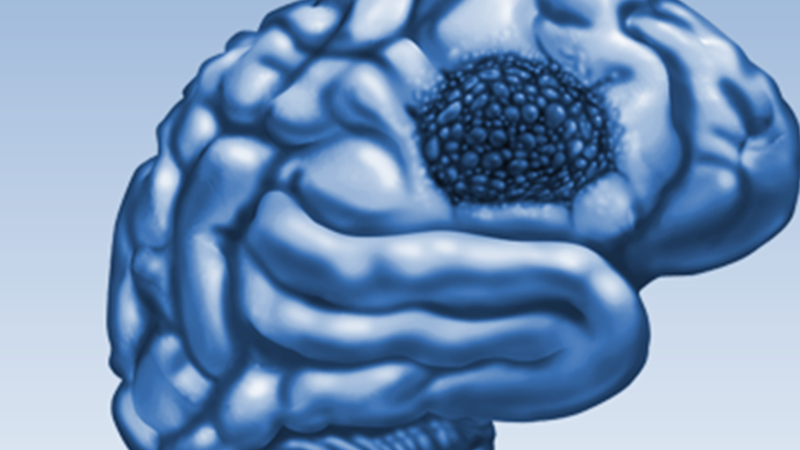 FDA evaluated drug for brain cancer