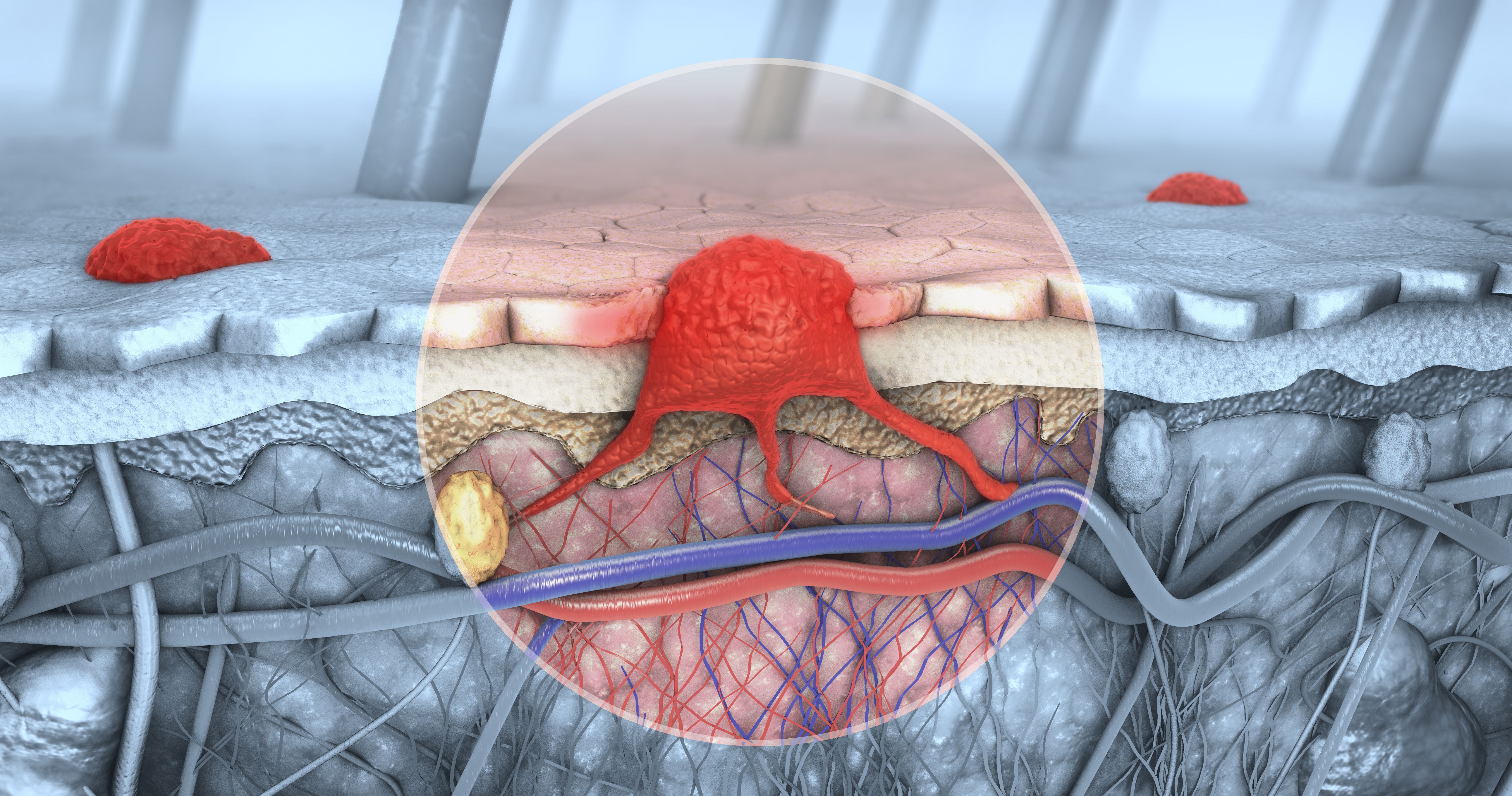 Active surveillance of patients who have sentinel node positive