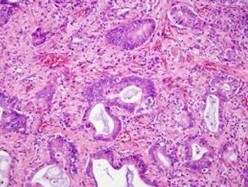 image of NSCLC